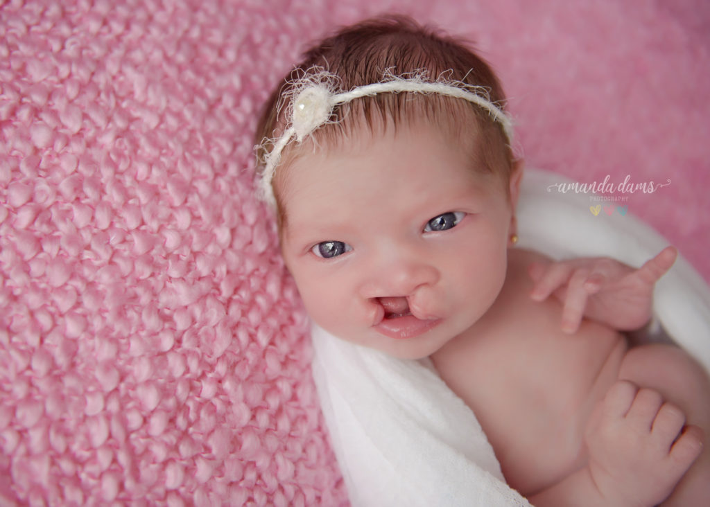 cleft-lips-newborn-baby-girl-amanda-dams-photography